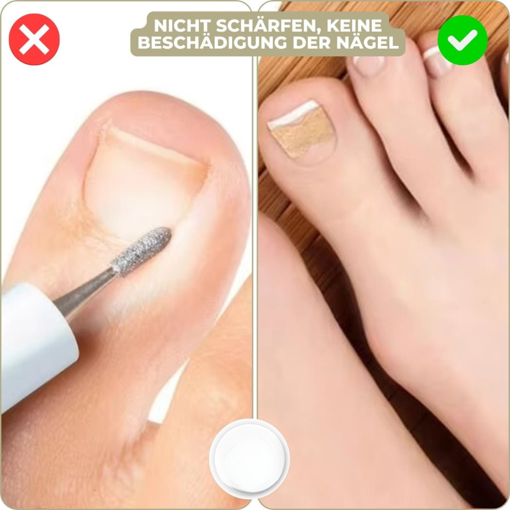 NailStrip™ | Voorkom ingegroeide nagels pijnvrij!