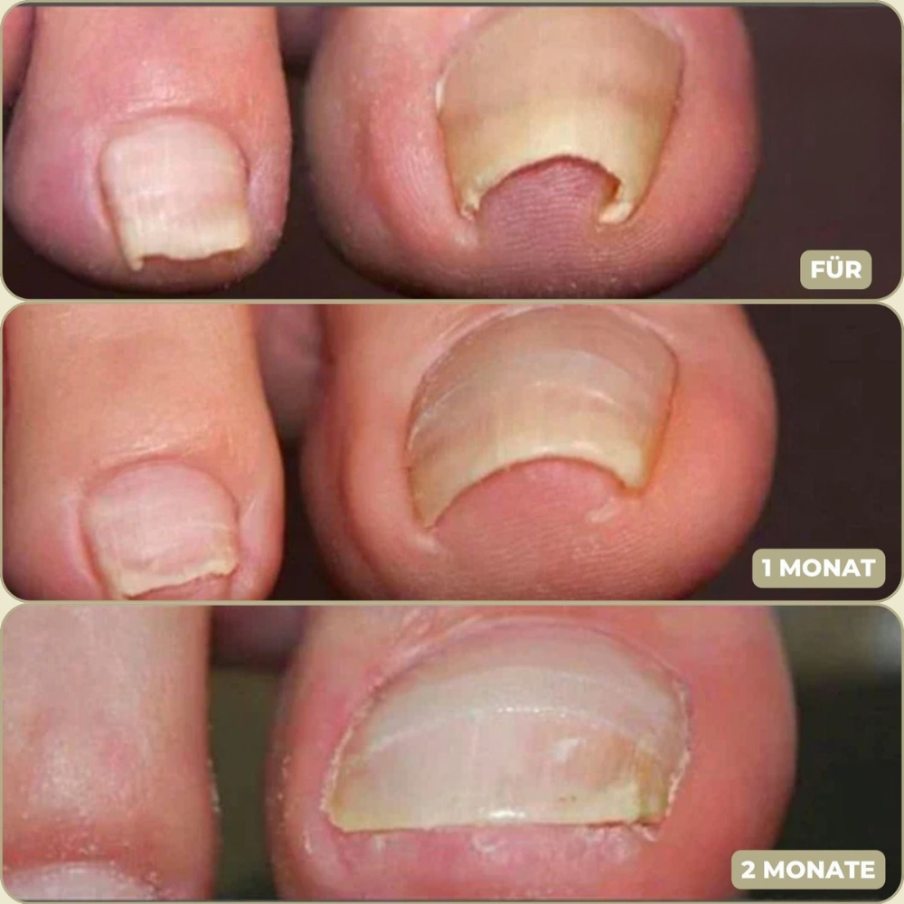 NailStrip™ | Voorkom ingegroeide nagels pijnvrij!