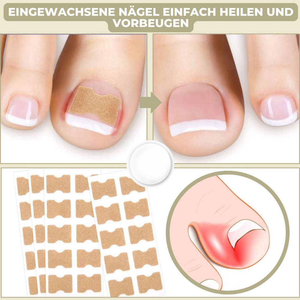 NailStrip™ | Voorkom ingegroeide nagels pijnvrij!