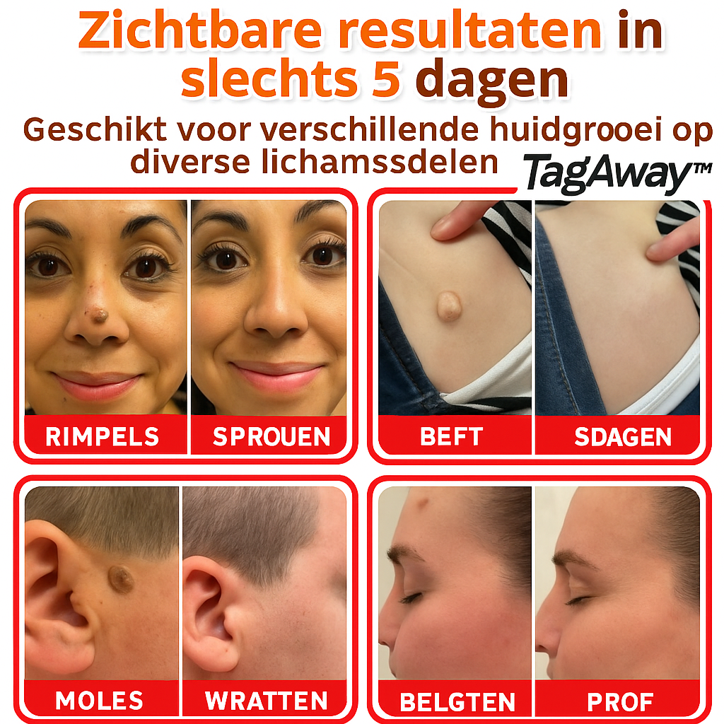 TagAway™ | Verwijder steelwratjes binnen 5 dagen!