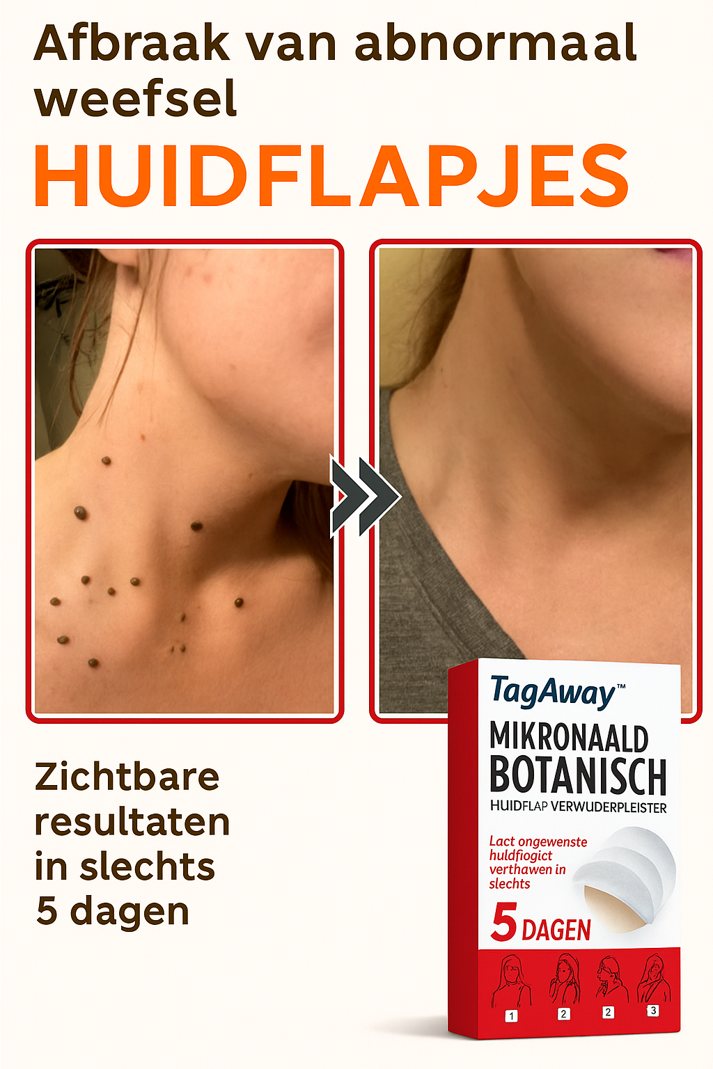 TagAway™ | Verwijder steelwratjes binnen 5 dagen!