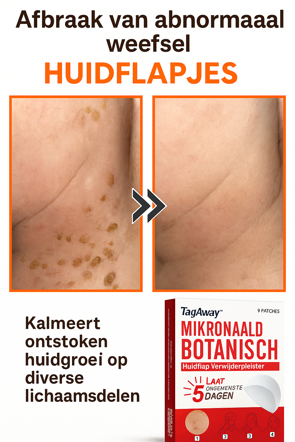 TagAway™ | Verwijder steelwratjes binnen 5 dagen!