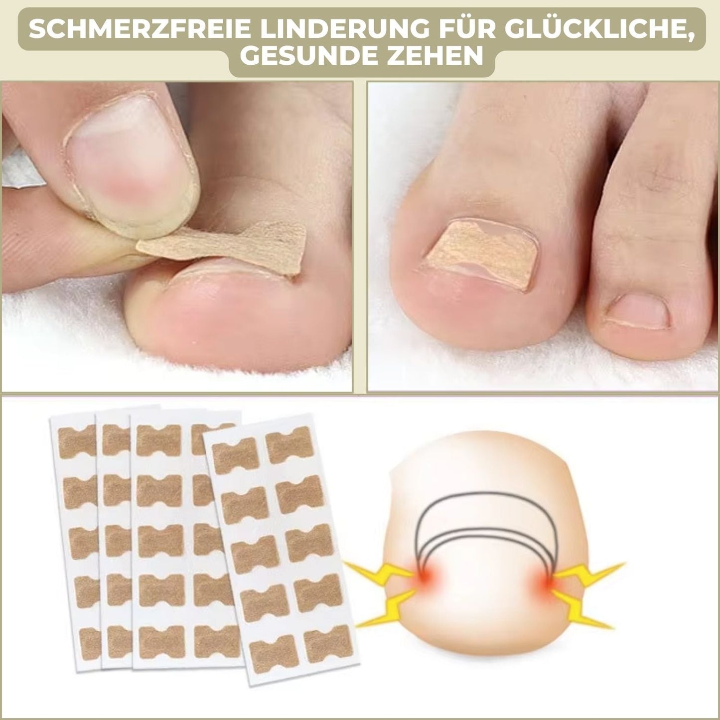 NailStrip™ | Voorkom ingegroeide nagels pijnvrij!