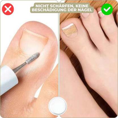 NailStrip™ | Voorkom ingegroeide nagels pijnvrij!