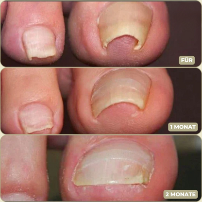 NailStrip™ | Voorkom ingegroeide nagels pijnvrij!
