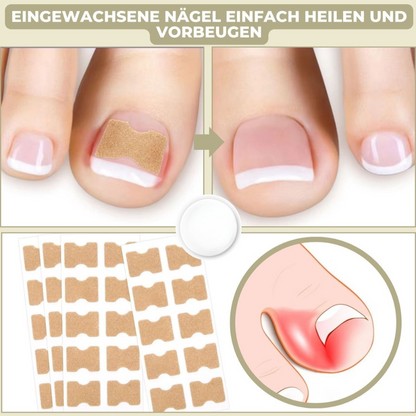 NailStrip™ | Voorkom ingegroeide nagels pijnvrij!