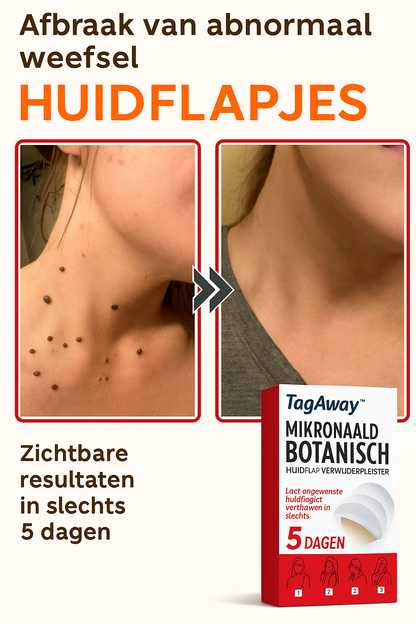 TagAway™ | Verwijder steelwratjes binnen 5 dagen!